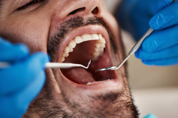 Best Knocked-Out Tooth (Avulsed Tooth) Treatment in Ansonia, OH